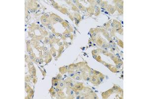 Immunohistochemistry of paraffin-embedded human stomach using ABCF2 antibody (ABIN5972445) at dilution of 1/100 (40x lens). (ABCF2 Antikörper)