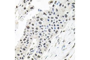 Immunohistochemistry of paraffin-embedded human lung cancer using CDCA8 antibody. (CDCA8 Antikörper)