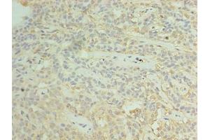 Immunohistochemistry of paraffin-embedded human breast cancer using ABIN7170641 at dilution of 1:100 (RBM11 Antikörper  (AA 115-278))
