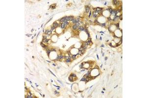 Immunohistochemistry of paraffin-embedded human liver cancer using RPH3A antibody (ABIN6128668, ABIN6147094, ABIN6147096 and ABIN6217639) at dilution of 1:100 (40x lens). (RPH3A Antikörper  (AA 1-280))