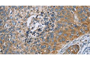 Immunohistochemistry of paraffin-embedded Human cervical cancer tissue using ZMYND11 Polyclonal Antibody at dilution 1:70 (ZMYND11 Antikörper)