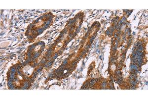 Immunohistochemistry of paraffin-embedded Human colon cancer using CLP36 Polyclonal Antibody at dilution of 1:30 (PDLIM1 Antikörper)