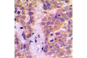 Immunohistochemical analysis of Caspase 9 staining in human breast cancer formalin fixed paraffin embedded tissue section. (Caspase 9 Antikörper  (Center))