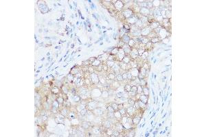 Immunohistochemistry of paraffin-embedded human breast cancer using EIF4G1 Rabbit pAb (ABIN6134646, ABIN6140092, ABIN6140093 and ABIN6221701) at dilution of 1:100 (40x lens). (EIF4G1 Antikörper  (AA 400-500))