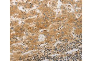 Immunohistochemistry of Human lung cancer using PPAP2A Polyclonal Antibody at dilution of 1:50 (PLPP1 Antikörper)