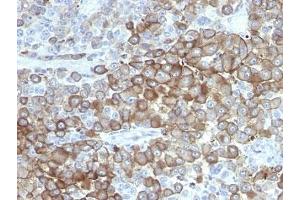 Formalin-fixed, paraffin-embedded human melanoma stained with Melanoma antibody. (Melanoma Antikörper)