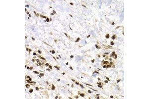 Immunohistochemistry of paraffin-embedded human kidney cancer using SUMO4 Antibody. (SUMO4 Antikörper)