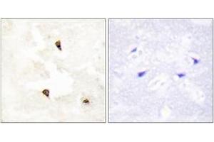 Immunohistochemistry analysis of paraffin-embedded human breast carcinoma tissue, using TP53I11 Antibody. (TP53I11 Antikörper  (AA 71-120))