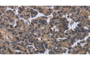 Immunohistochemistry of paraffin-embedded Human ovarian cancer using ITGAE Polyclonal Antibody at dilution of 1:50 (CD103 Antikörper)
