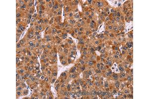 Immunohistochemistry of Human colon cancer using CARD11 Polyclonal Antibody at dilution of 1:40 (CARD11 Antikörper)