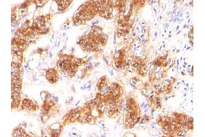 Formalin-fixed, paraffin-embedded human Breast Carcinoma stained with Milk Fat Globule Monoclonal Antibody (SPM291) (MFGE8 Antikörper)