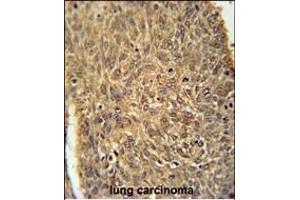 ATG13 Antibody (N-term) (ABIN653882 and ABIN2843129) immunohistochemistry analysis in formalin fixed and paraffin embedded human lung carcinoma followed by peroxidase conjugation of the secondary antibody and DAB staining.