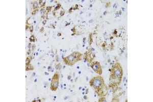 Immunohistochemistry of paraffin-embedded human liver cancer using GATM Antibody (ABIN5973965) at dilution of 1/100 (40x lens). (GATM Antikörper)