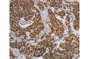 Immunohistochemistry of Human colon cancer using CCL21 Polyclonal Antibody at dilution of 1:40