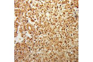 Immunohistochemistry of paraffin-embedded Osteosarcoma using FGF2 antibody. (FGF2 Antikörper  (AA 143-288))