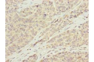 Immunohistochemistry of paraffin-embedded human ovarian cancer using ABIN7145848 at dilution of 1:100 (KCTD19 Antikörper  (AA 490-751))