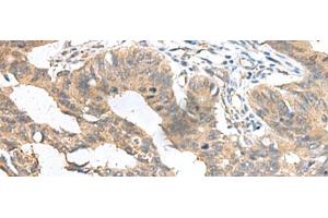 Immunohistochemistry of paraffin-embedded Human colorectal cancer tissue using MIA Polyclonal Antibody at dilution of 1:100(x200) (MIA Antikörper)