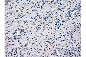 Immunohistochemical staining of paraffin-embedded Adenocarcinoma of breast tissue using anti-STK3 mouse monoclonal antibody.