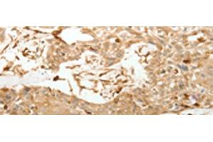 Immunohistochemistry of paraffin-embedded Human esophagus cancer tissue using VMA21 Polyclonal Antibody at dilution of 1:150(x200)