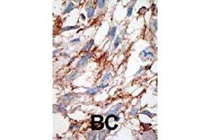 Formalin-fixed and paraffin-embedded human cancer tissue reacted with ISG15 polyclonal antibody  , which was peroxidase-conjugated to the secondary antibody, followed by DAB staining. (ISG15 Antikörper  (N-Term))