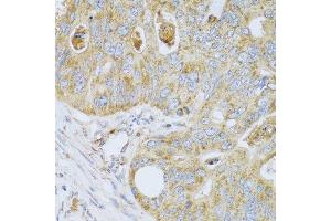 Immunohistochemistry of paraffin-embedded human colon carcinoma using PSG1 antibody at dilution of 1:100 (40x lens). (PSG1 Antikörper)