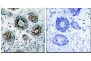 Immunohistochemical analysis of paraffin-embedded human breast carcinoma tissue using GAP43(Ab-41) Antibody(left) or the same antibody preincubated with blocking peptide(right). (GAP43 Antikörper)
