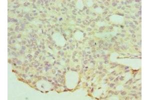 Immunohistochemistry of paraffin-embedded human endommetrial cancer using ABIN7155970 at dilution of 1:100 (HYAL1 Antikörper  (AA 136-435))