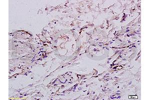 Formalin-fixed and paraffin embedded:human colon carcinoma labeled with Anti-factor VIII(FVIII) (human) Polyclonal Antibody (ABIN728000), Unconjugated at 1:200, followed by conjugation to the secondary antibody and DAB staining (Factor VIII Antikörper  (AA 1451-1550))