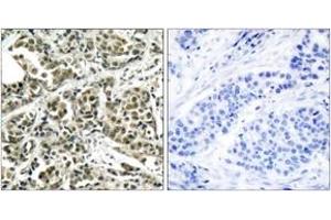 Immunohistochemistry analysis of paraffin-embedded human breast carcinoma tissue, using BRCA1 (Ab-1524) Antibody. (BRCA1 Antikörper  (AA 1491-1540))
