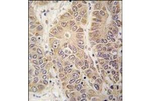 Formalin-fixed and paraffin-embedded human hepatocarcinoma tissue reacted with HARS antibody (N-term), which was peroxidase-conjugated to the secondary antibody, followed by DAB staining.