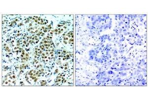 Immunohistochemical analysis of paraffin-embedded human breast carcinoma tissue, using p90RSK (phospho-Thr348) antibody (E011105). (RPS6KA3 Antikörper  (pThr348))