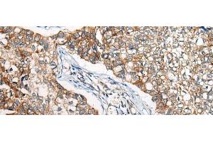Immunohistochemistry of paraffin-embedded Human lung cancer tissue using BBS12 Polyclonal Antibody at dilution of 1:50(x200) (BBS12 Antikörper)