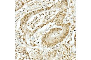 Immunohistochemistry of paraffin-embedded human colon carcinoma using TOPBP1 Rabbit pAb (ABIN6129493, ABIN6149398, ABIN6149401 and ABIN6221465) at dilution of 1:50 (40x lens).