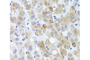 Immunohistochemistry of paraffin-embedded Human liver damage using ATP7A Polyclonal Antibody at dilution of 1:100 (40x lens). (ATP7A Antikörper)