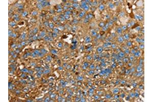 The image on the left is immunohistochemistry of paraffin-embedded Human breast cancer tissue using ABIN7130083(LGALS3BP Antibody) at dilution 1/25, on the right is treated with fusion protein. (LGALS3BP Antikörper)