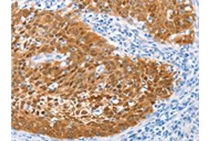 The image on the left is immunohistochemistry of paraffin-embedded Human cervical cancer tissue using ABIN7129916(IRF6 Antibody) at dilution 1/50, on the right is treated with fusion protein. (IRF6 Antikörper)
