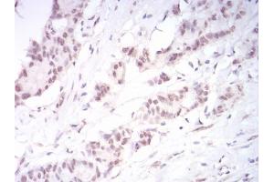 Immunohistochemical analysis of paraffin-embedded colon cancer tissues using DNMT3B mouse mAb with DAB staining. (DNMT3B Antikörper  (AA 1-150))