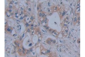 Detection of FBN1 in Human Pancreatic cancer Tissue using Polyclonal Antibody to Fibrillin 1 (FBN1) (Fibrillin 1 Antikörper  (AA 246-389))