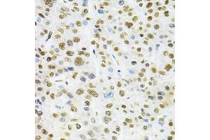 Immunohistochemistry of paraffin-embedded human liver cancer using B/B/SM Antibody  at dilution of 1:200 (40x lens). (SMARCE1 Antikörper  (AA 1-411))