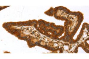 Immunohistochemistry of paraffin-embedded Human thyroid cancer using TP53I11 Polyclonal Antibody at dilution of 1:40 (TP53I11 Antikörper)