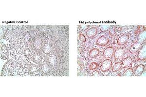 Immunohistochemistry analysis of formalin-fixed, paraffin-embedded human colon tumor tissue stained with Fas polyclonal antibody,  at 10 μg/mL. (FAS Antikörper)