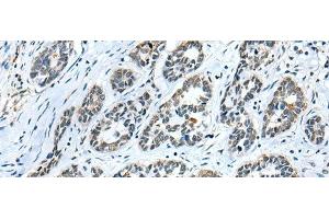 Immunohistochemistry of paraffin-embedded Human esophagus cancer tissue using GMFB Polyclonal Antibody at dilution of 1:25(x200)