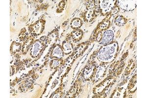 ABIN7096023 and ABIN7100085 at 1/100 staining human ovarian cancer by IHC-P. (MAPK1IP1L Antikörper)