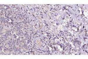 ABIN6273158 at 1/100 staining Human lymph cancer tissue by IHC-P. (SACM1L Antikörper  (Internal Region))