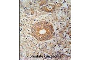 S35E2 Antibody (N-term) (ABIN654754 and ABIN2844438) immunohistochemistry analysis in formalin fixed and paraffin embedded human prostate carcinoma followed by peroxidase conjugation of the secondary antibody and DAB staining. (SLC35E2 Antikörper  (N-Term))