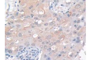 IHC-P analysis of Human Breast Cancer Tissue, with DAB staining. (GAMT Antikörper  (AA 64-236))