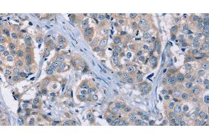 Immunohistochemistry of paraffin-embedded Human breast cancer using KCNQ5 Polyclonal Antibody at dilution of 1:30