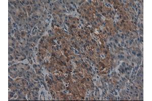 Immunohistochemical staining of paraffin-embedded Carcinoma of kidney using anti-CPA1 (ABIN2452540) mouse monoclonal antibody.