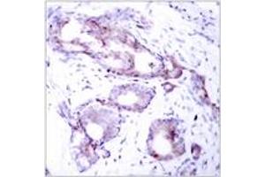 Immunohistochemistry analysis of paraffin-embedded human breast carcinoma, using Myc (Phospho-Ser373) Antibody. (c-MYC Antikörper  (pSer373))