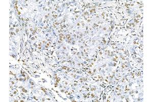 Acetyl-histone H4 (Lys16) Antibody at 1/100 staining Human liver cancer by IHC-P.